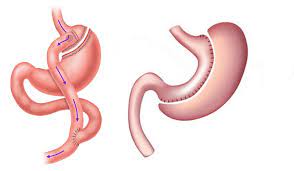 Gastric Bypass 