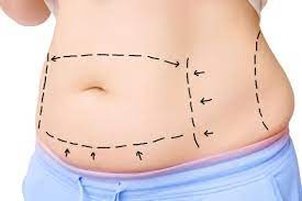 Abdominoplastie