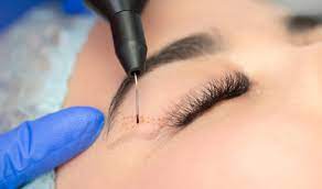 Laser Eyelid Surgery