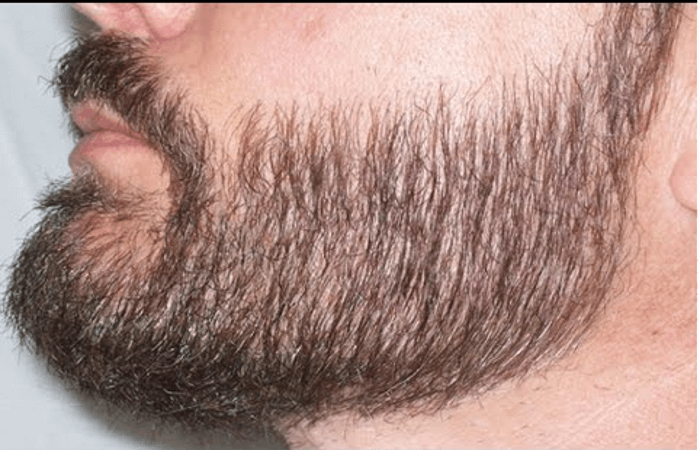 Beard Transplantation