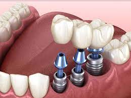 Transplantul dentar