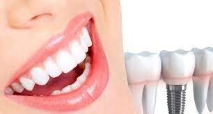Types of dental implants in Turkey